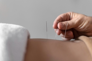 The Basics of Acupuncture